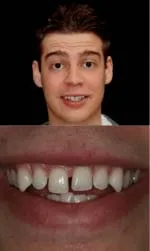 same day veneers before and after aaron before