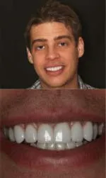 same day veneers before and after after