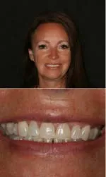 sharon veneers before and after salt lake city before