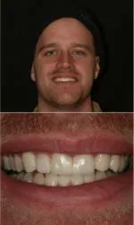 veneers before and after in salt lake city ut michael after