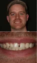 veneers before and after in salt lake city ut michael before